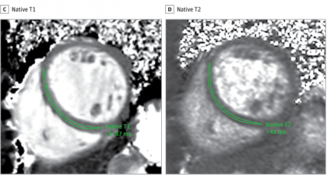 Signs of Cardiac Damage Even in Younger, Nonhospitalized COVID-19 Patients